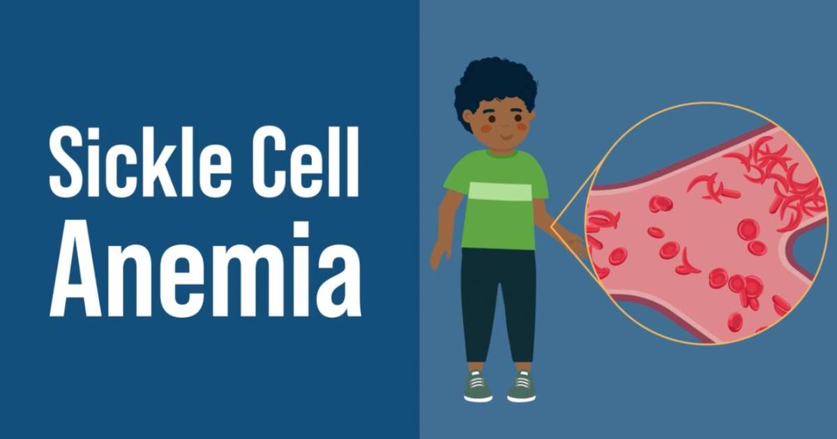 Sickle Cell Anemia