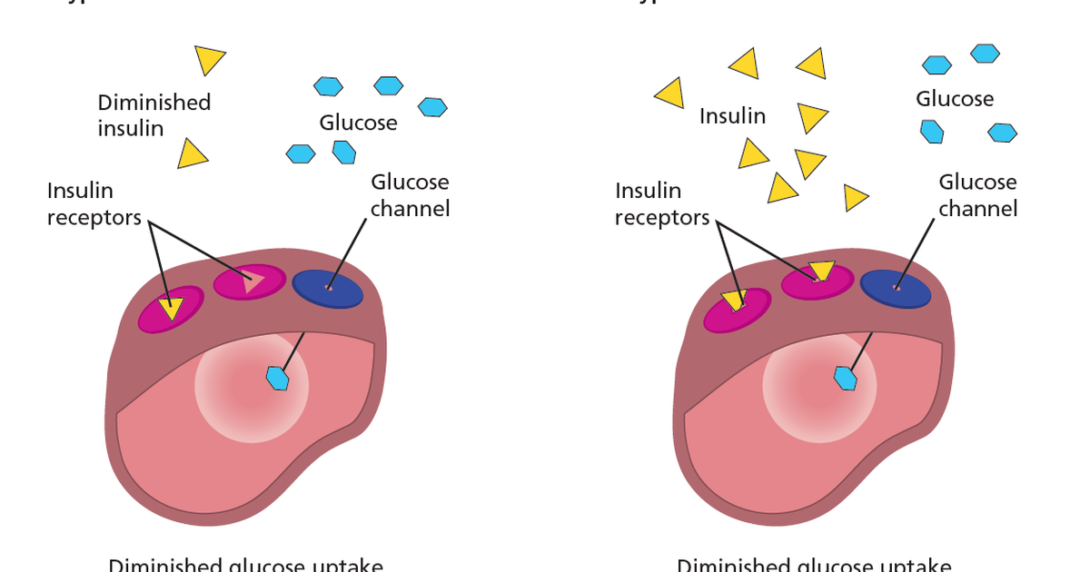 Diabetes Types 1 and 2