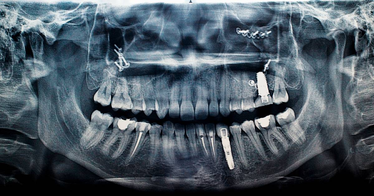 Metals and Minerals in Medical Implants