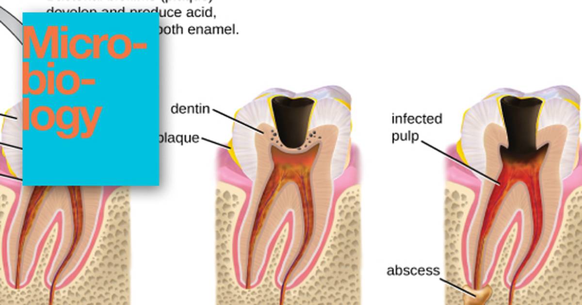 Microbial Diseases of the Mouth and Oral Cavity