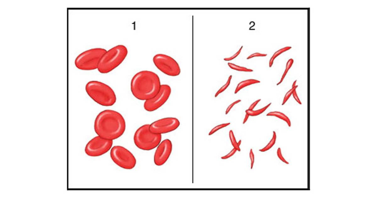 Student Handout: From Gene To Disease Sickle Cell Anemia