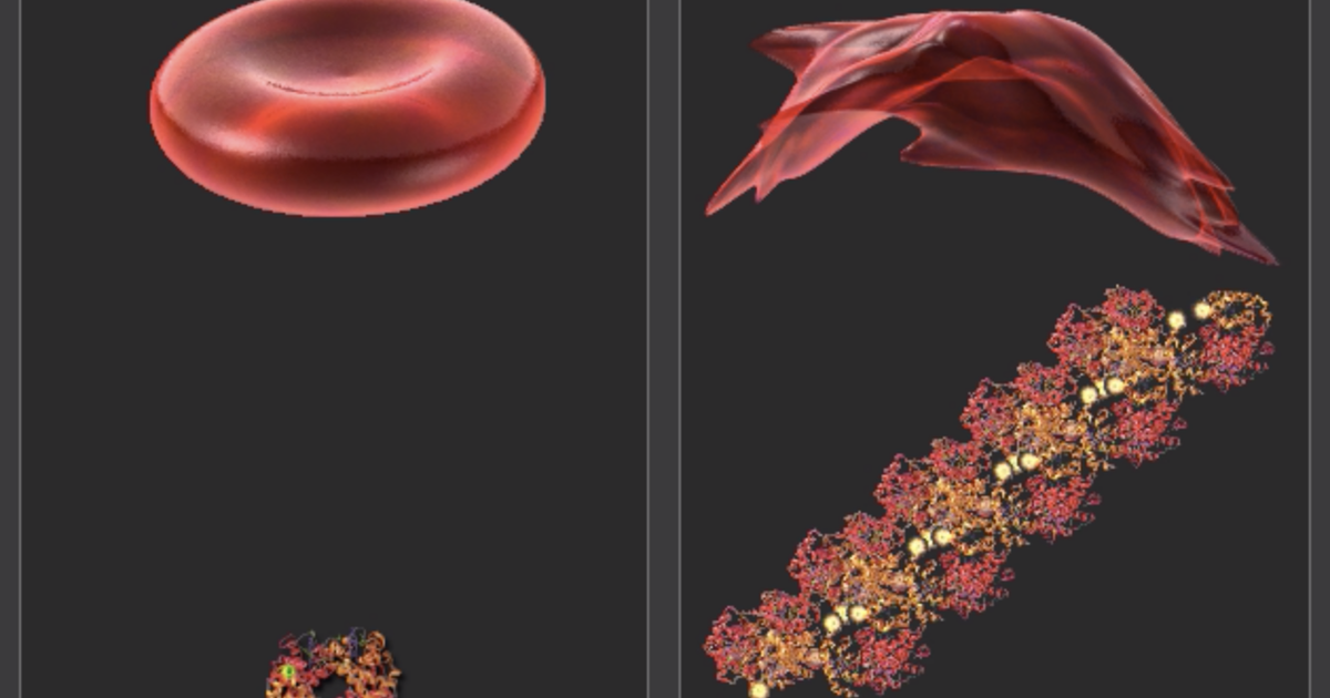 Sickle Cell Anemia: Functional Validation of Genetic Mutations and Human Disease