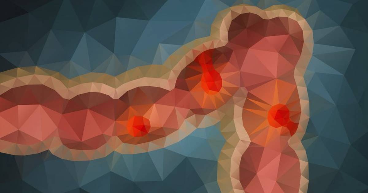 What Is Familial Adenomatous Polyposis?