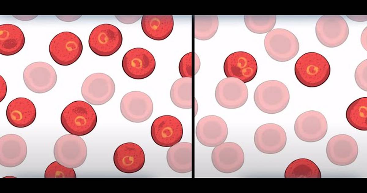 Sickle Cell: Natural Selection in Humans