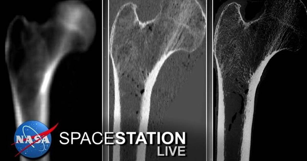 Space Station Live: A New Measure of Bone Strength